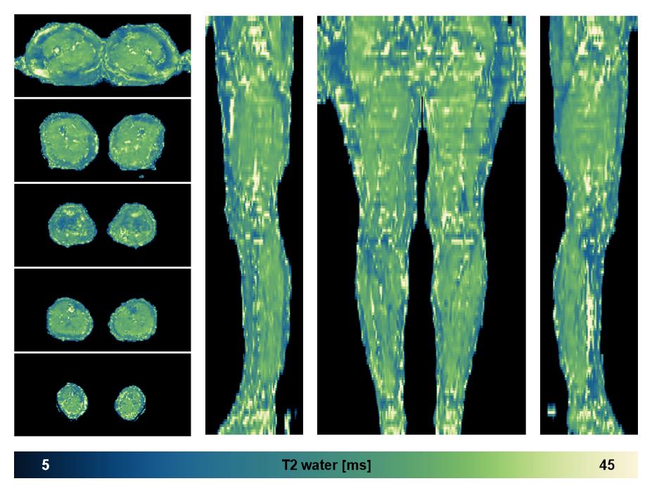 The water only T2 relaxation time of the lower extremity obtained from multi echo spin echo t2 mapping with EPG based reconstruction.